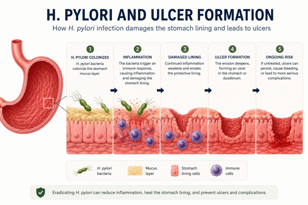 H. pylori infection contributing to peptic ulcer development.