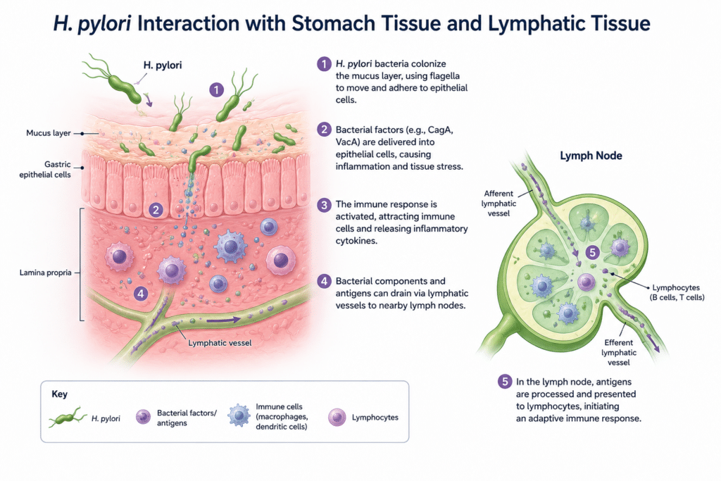 H. pylori infection affecting stomach lining and lymphatic tissue.