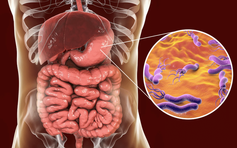 Understanding the connection between H. pylori and stomach ulcers.