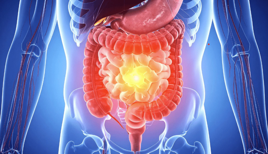 Digestive discomfort and gut imbalance discussions involving H. pylori